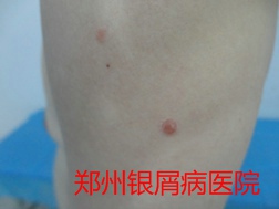 郑州牛皮癣医院治疗牛皮癣图片