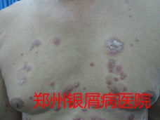 郑州牛皮癣医院治疗牛皮癣图片