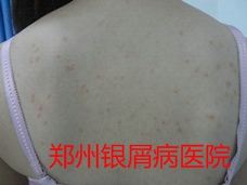 郑州牛皮癣医院治疗牛皮癣图片