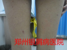 郑州牛皮癣医院治疗牛皮癣图片