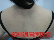 郑州牛皮癣医院治疗牛皮癣图片