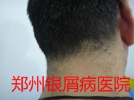 郑州牛皮癣医院治疗牛皮癣图片