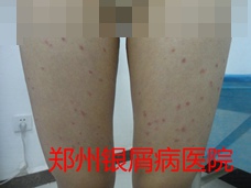 郑州牛皮癣医院治疗牛皮癣图片