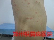 郑州牛皮癣医院治疗牛皮癣图片