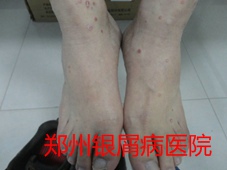 郑州牛皮癣医院治疗牛皮癣图片
