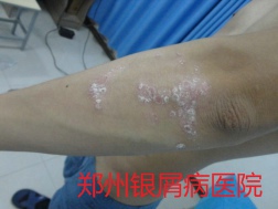 郑州牛皮癣医院治疗牛皮癣图片
