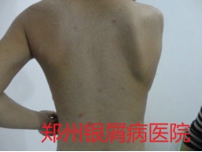 郑州牛皮癣医院治疗牛皮癣图片