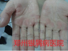 郑州牛皮癣医院治疗牛皮癣图片