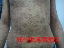 郑州牛皮癣医院治疗牛皮癣图片