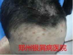 郑州牛皮癣医院治疗牛皮癣图片