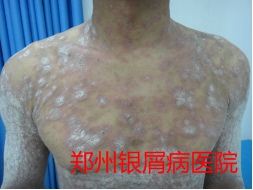 郑州牛皮癣医院治疗牛皮癣图片