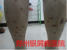 郑州牛皮癣医院治疗牛皮癣图片