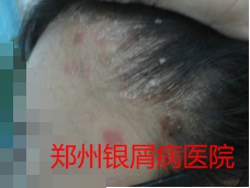 郑州牛皮癣医院治疗牛皮癣图片