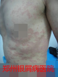 郑州牛皮癣医院治疗牛皮癣图片