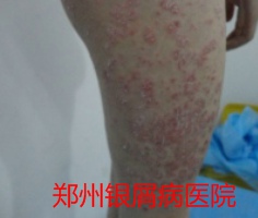 郑州牛皮癣医院治疗牛皮癣图片
