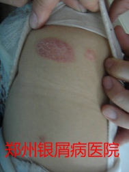 郑州牛皮癣医院治疗牛皮癣图片