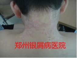 郑州牛皮癣医院治疗牛皮癣图片