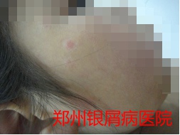 郑州牛皮癣医院治疗牛皮癣图片