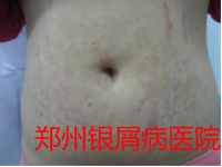郑州牛皮癣医院治疗牛皮癣图片
