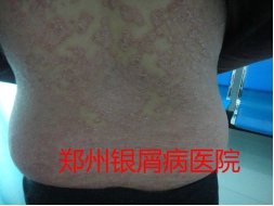 郑州牛皮癣医院治疗牛皮癣图片