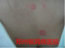 郑州牛皮癣医院治疗牛皮癣图片
