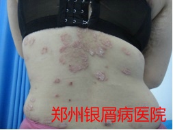 郑州牛皮癣医院治疗牛皮癣图片
