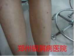 郑州牛皮癣医院治疗牛皮癣图片