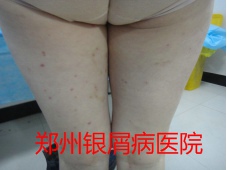 郑州牛皮癣医院
