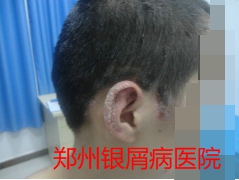 郑州牛皮癣医院