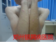 郑州牛皮癣医院