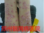 郑州牛皮癣医院治疗牛皮癣图片