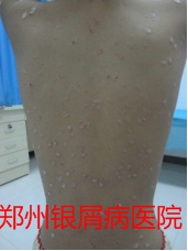 郑州牛皮癣医院治疗牛皮癣图片