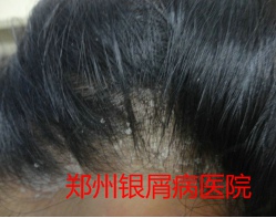 郑州牛皮癣医院治疗牛皮癣图片
