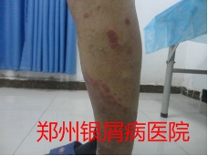 郑州牛皮癣医院治疗牛皮癣图片