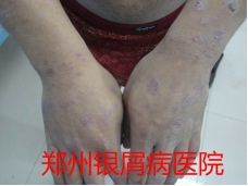 郑州牛皮癣医院治疗牛皮癣图片