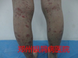 郑州牛皮癣医院治疗牛皮癣图片