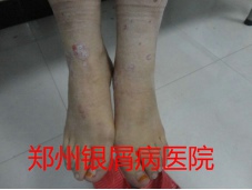 牛皮癣治疗图片