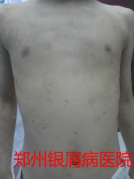 牛皮癣治疗图片