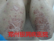 牛皮癣治疗图片