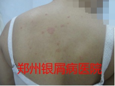 郑州治疗牛皮癣图片