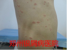 郑州治疗牛皮癣图片