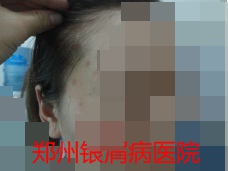 郑州治疗牛皮癣图片