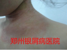 郑州治疗牛皮癣图片