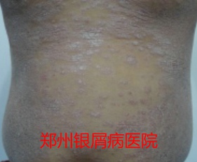郑州牛皮癣医院治疗牛皮癣图片