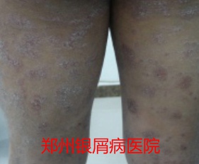 郑州牛皮癣医院治疗牛皮癣图片