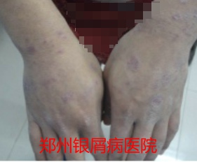 郑州牛皮癣医院治疗牛皮癣图片