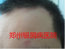郑州牛皮癣医院治疗牛皮癣图片