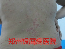 郑州牛皮癣医院治疗牛皮癣图片