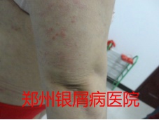 郑州牛皮癣医院治疗牛皮癣图片