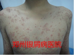 郑州牛皮癣医院治疗牛皮癣图片